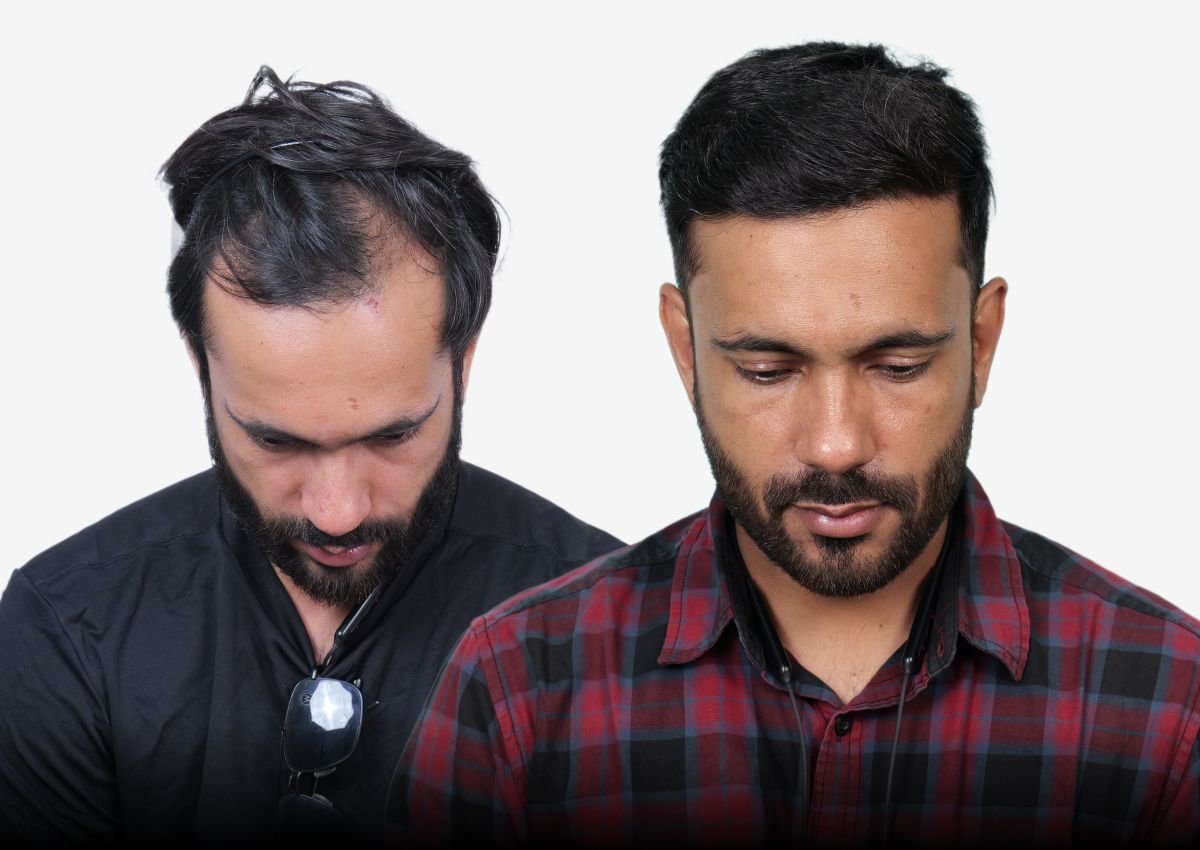 Before and after result - Influencer Hair Transplant