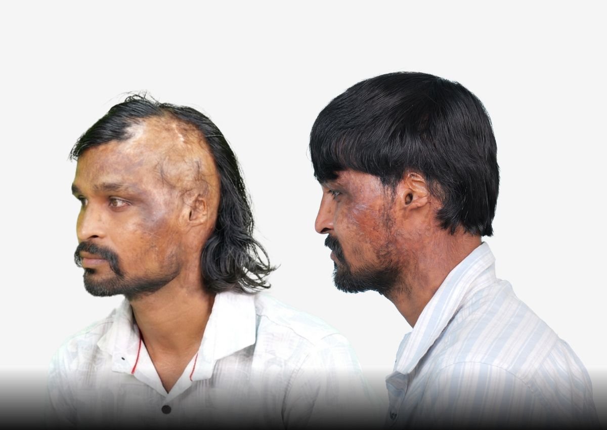 Before and after result - Burn Scar hair Transplant