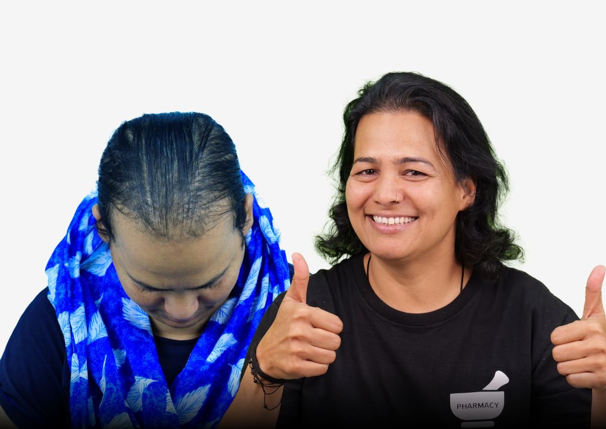 Before and after result - Female Hair Transplant