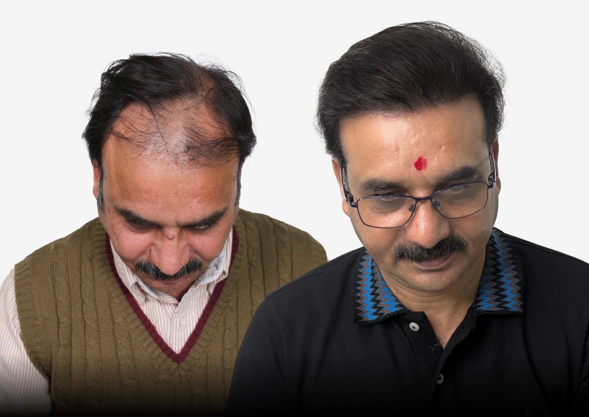 Before and after result - Senior Citizen Hair Transplant