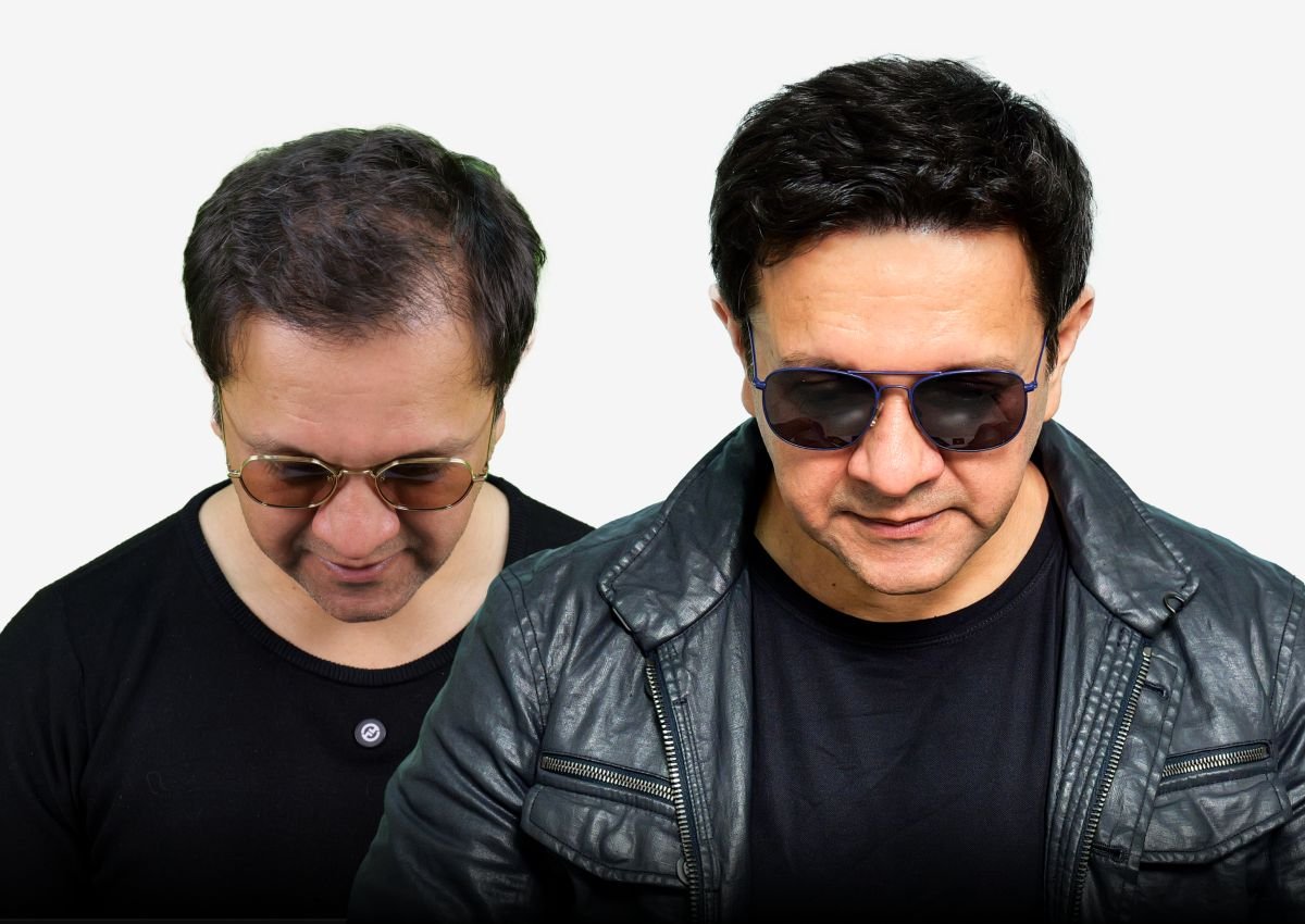 Before and after result - Celebrity Hair Transplant