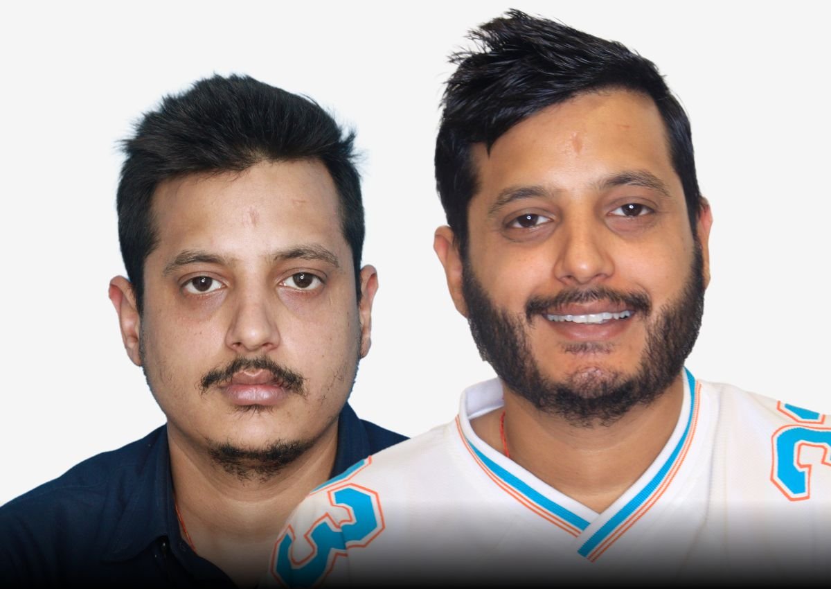 Before and after result - International Hair Transplant