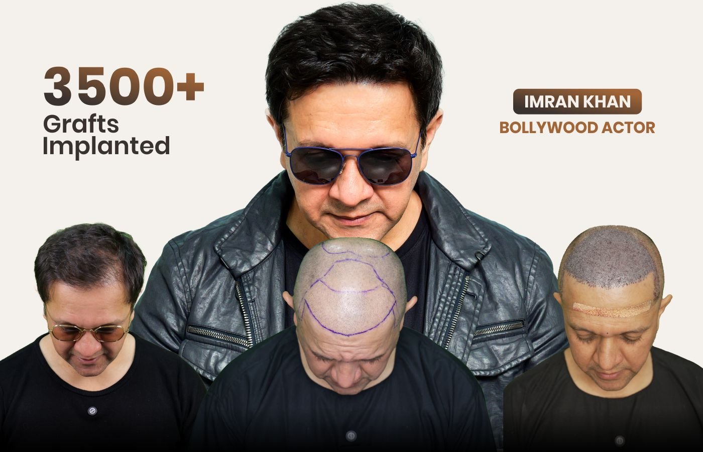 Hair restoration consultation